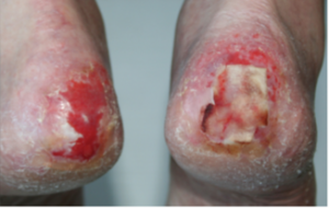 wound-healing
