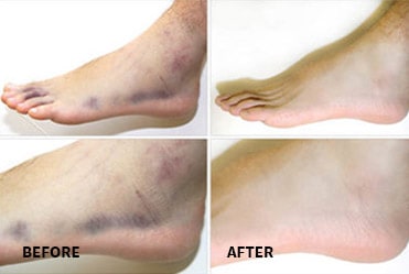 Acute Ankle Sprain Before And After