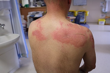 bioflex laser brampton burn healing Bioflex Laser Brampton Burn Healing