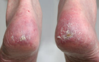 Bioflex Laser Brampton Wound Healing After