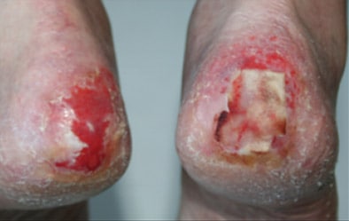 Bioflex Laser Brampton Wound Healing Before