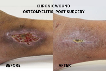 Dermal Ulcers Secondary Before And After