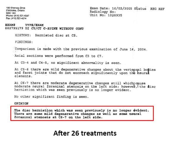 Disc Herniation MRI Report Photo After