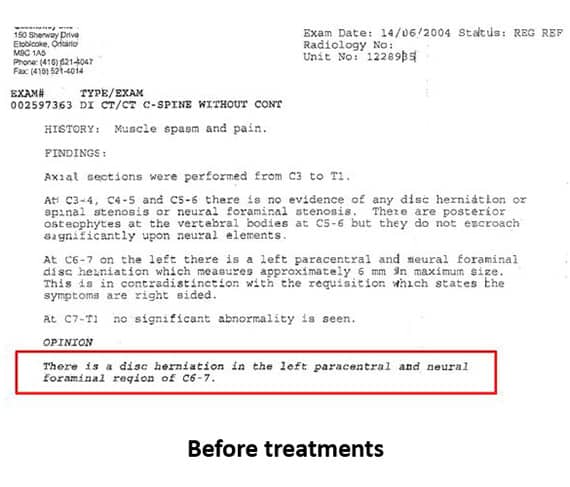 Disc Herniation MRI Report Photo Before