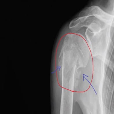 Fracture Neck Humerus of the Shoulder After