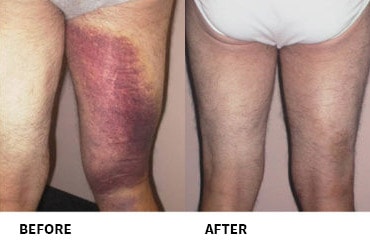 Hamstring Injury Before And After