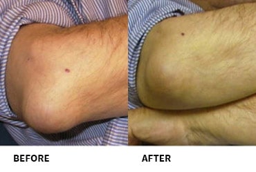 olecranon bursitis before and after Olecranon Bursitis Before And After