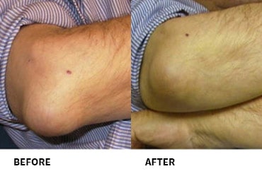 Olecranon Bursitis Before And After