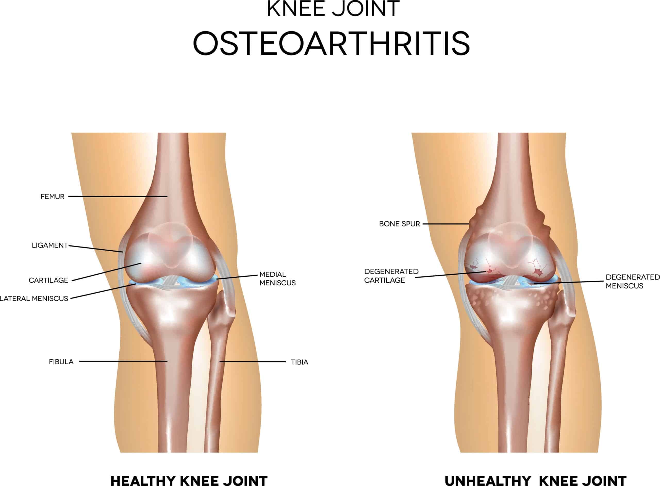 OA Knee